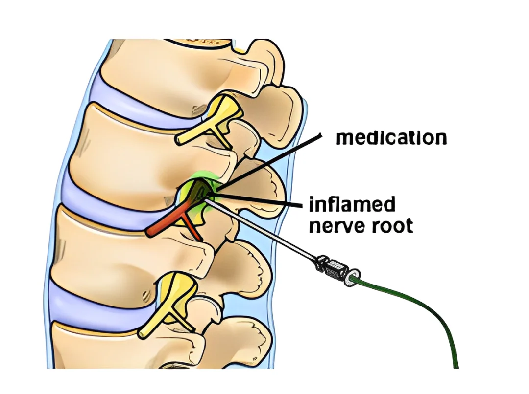 Image of a woman with back pain which is highlighted in red.